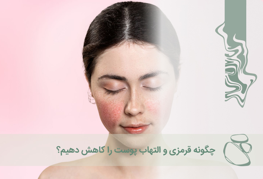 چگونه قرمزی و التهاب پوست را کاهش دهیم؟